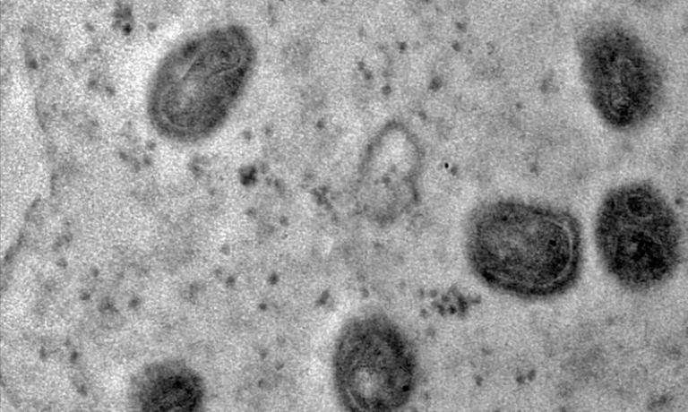 Presidente Prudente registra primeiro caso de mpox